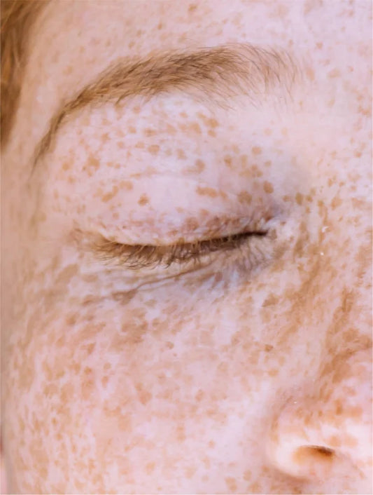 Targeted Dark Spot Care, 1% Kojic Acid